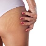 You Don't Have to Live With Stretch Marks