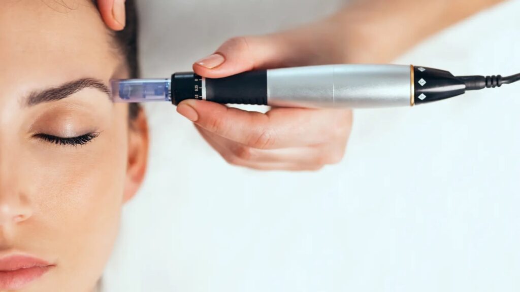 Microneedling for scar treatment is a popular method that helps improve skin texture and appearance effectively.