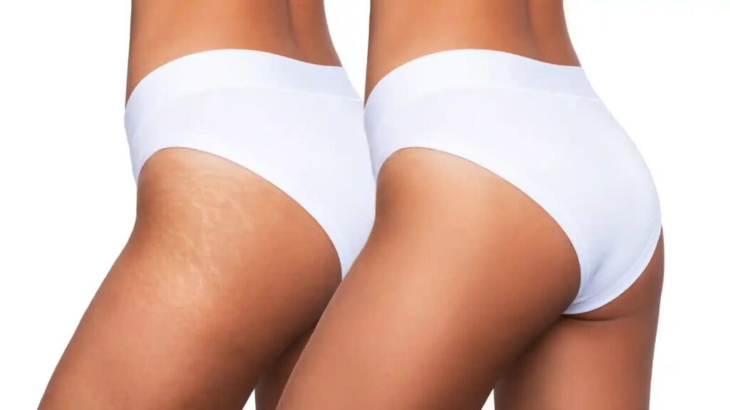 Get smooth skin with effective laser stretch mark removal treatments for lasting results.
