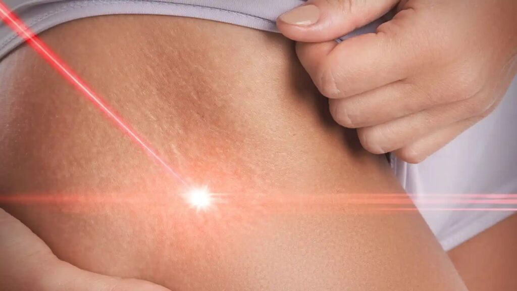Effective laser treatment for stretch marks can help restore your skin’s smooth, youthful look.