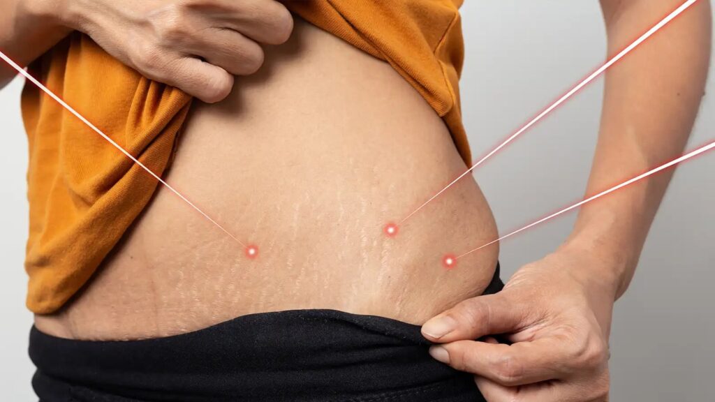 Pregnancy stretch marks are a common skin change that many women experience during and after pregnancy.