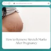 How to Remove Stretch Marks After Pregnancy