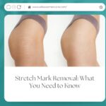 Stretch Mark Removal: What You Need to Know