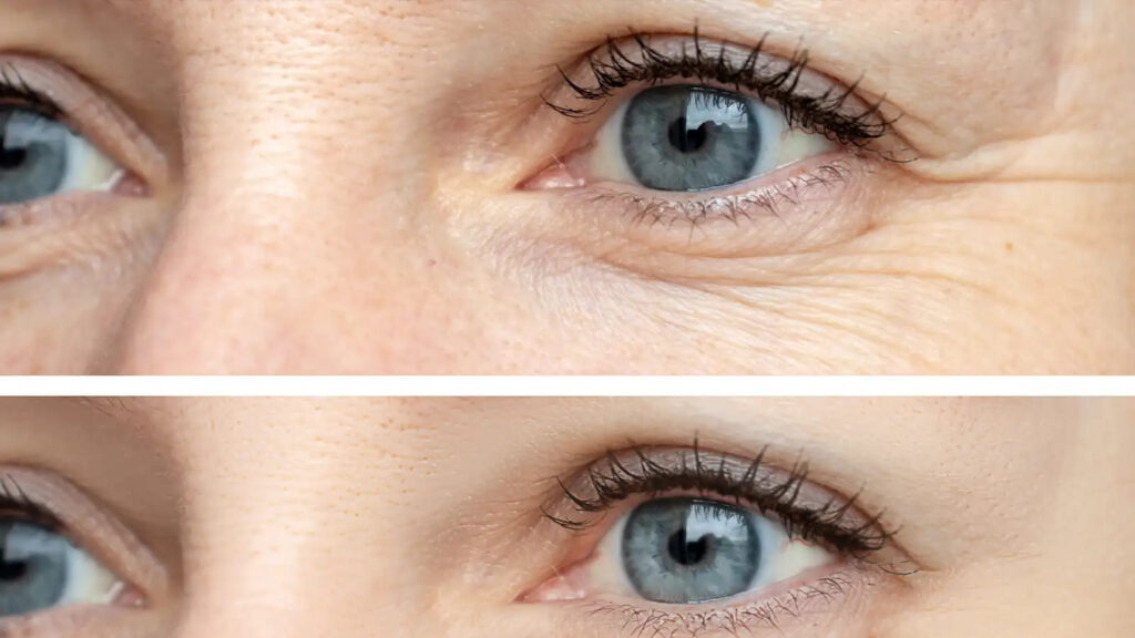 This image highlights the effectiveness of wrinkle reduction treatments in improving skin texture and appearance.