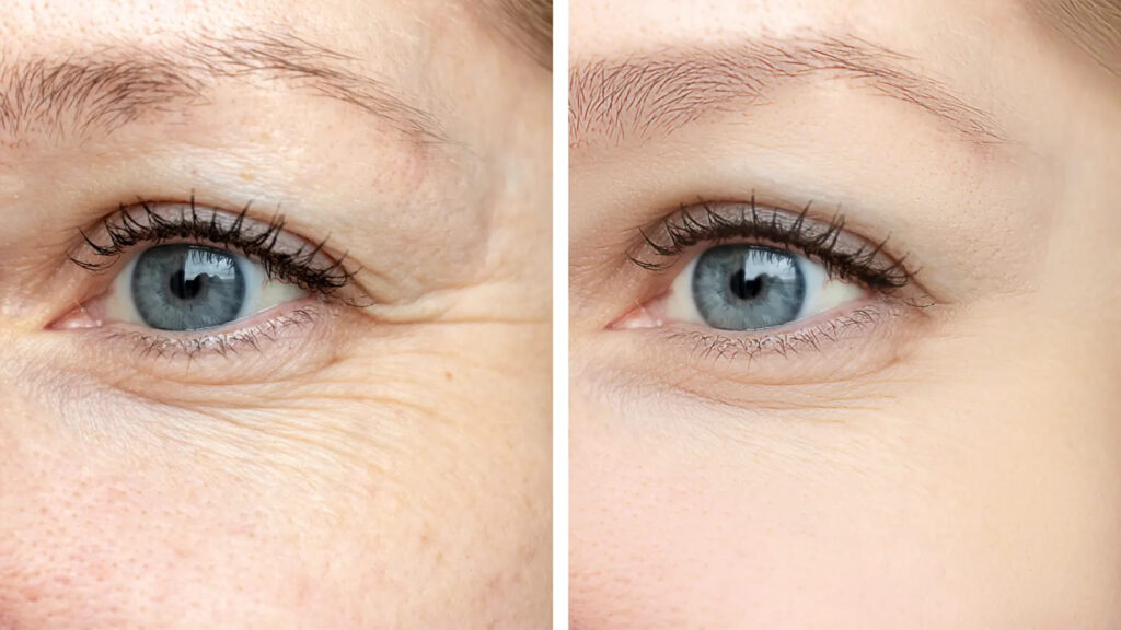 Essential Botox aftercare instructions to ensure safe and effective treatment results.