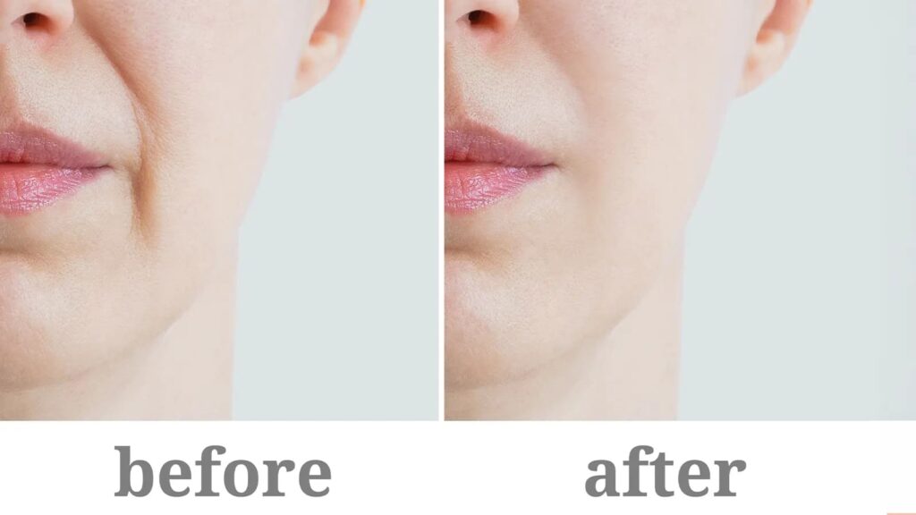 The difference between Botox and fillers lies in their use: Botox relaxes muscles, fillers add volume.