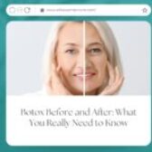 Botox Before and After: What You Really Need to Know