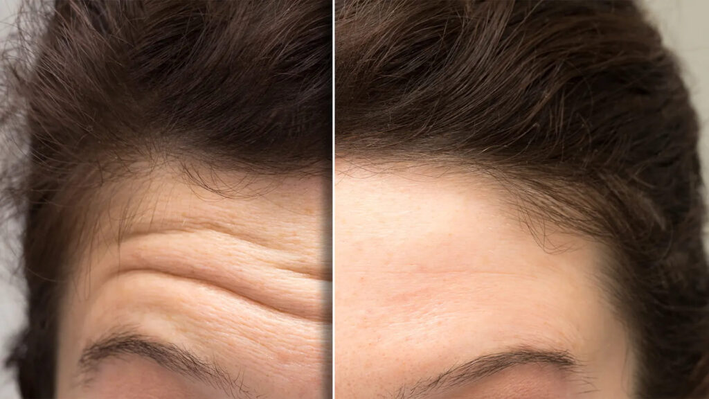 How to prepare for Botox treatment: essential tips to ensure a safe and effective procedure.