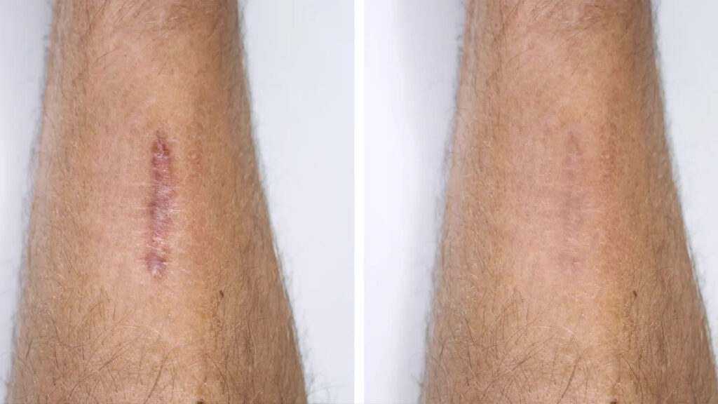 Aloe vera gel applied on skin helps reduce scars naturally and promotes faster healing.