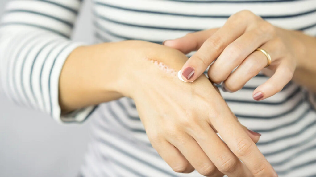 Coconut oil is a natural remedy that helps reduce the appearance of scars and promotes healthy skin healing.