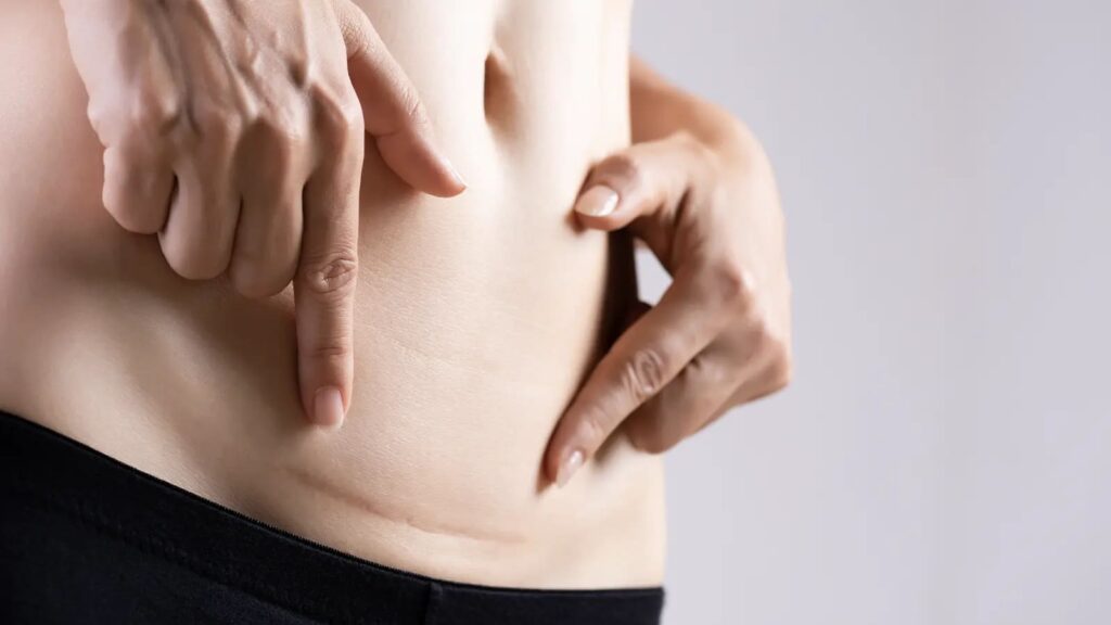 Discover effective home remedies for scars that help fade marks naturally using simple ingredients at home.