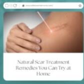 Natural Scar Treatment Remedies You Can Try at Home