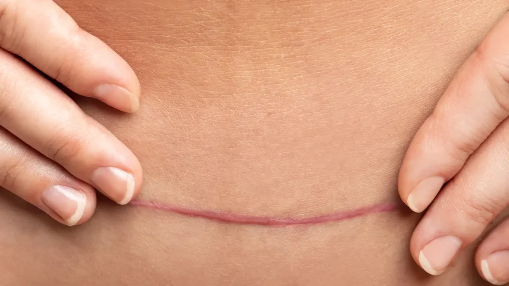 One of the top treatments for C-section scar improvement is CUTERA SECRET RF Microneedling.