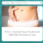 Post C-Section Scar Treatment with Elite Women's Care