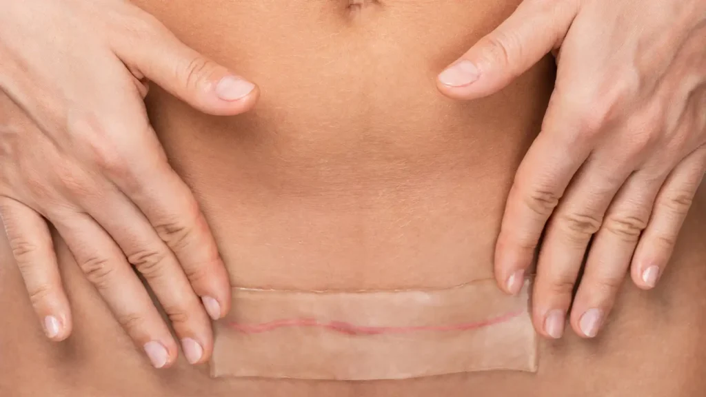 Scar reduction in Hoffman Estates: CUTERA SECRET is designed to make scars.
