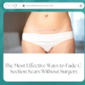 The Most Effective Ways to Fade C-Section Scars Without Surgery