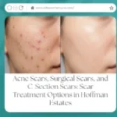 Acne Scars, Surgical Scars, and C-Section Scars: Scar Treatment Options in Hoffman Estates