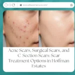 Acne Scars, Surgical Scars, and C-Section Scars: Scar Treatment Options in Hoffman Estates